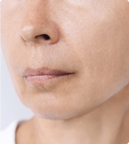 Botox Dubai now & Abu Dhabi