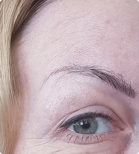 Botox treatment Dubai , Abu Dhabi & Sharjah