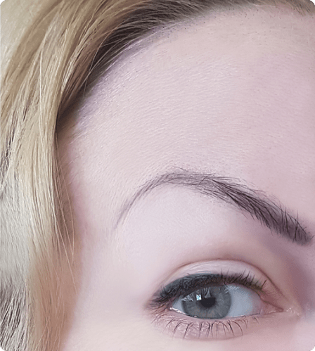 Botox treatment Dubai , Abu Dhabi & UAE